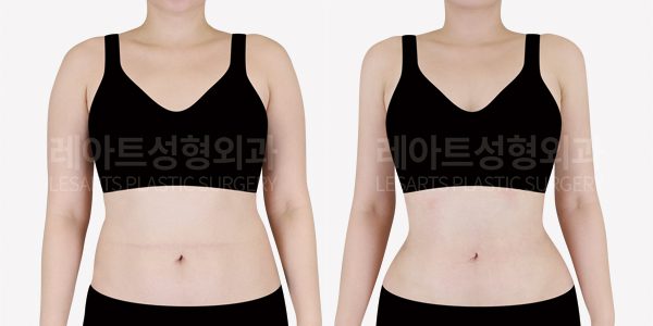 팔 지방흡입 전후 사진 (7개월 경과)