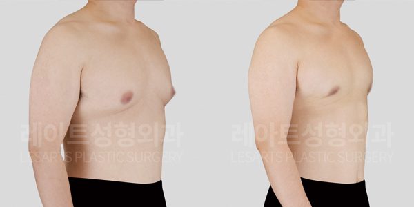 여유증 수술 회복은 얼마나 걸릴까? 가슴 돌출 교정 사례로 확인하기