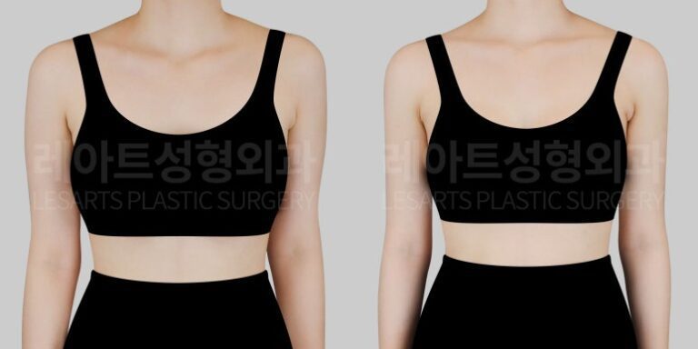 팔 지방흡입 전후사진 레아트 성형외과
