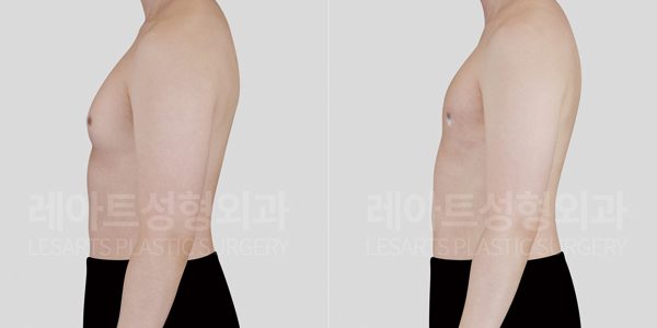 여유증 전후사진 레아트 성형외과