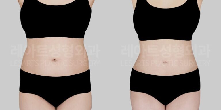 복부 지방흡입 전후사진 - 서용승 원장