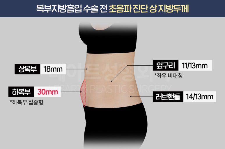 복부 지방흡입 수술 플랜