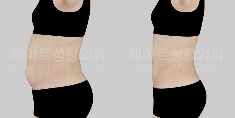 복부 지방흡입 전후 사진 옆모습