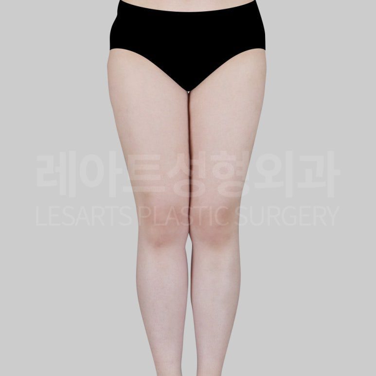 s-thight-liposuction-post22-01