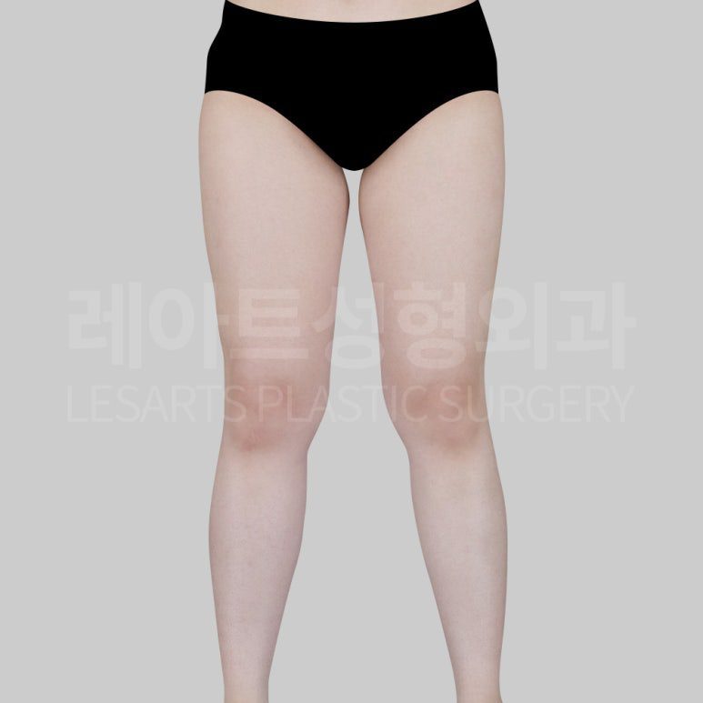 s-thight-liposuction-post22-02