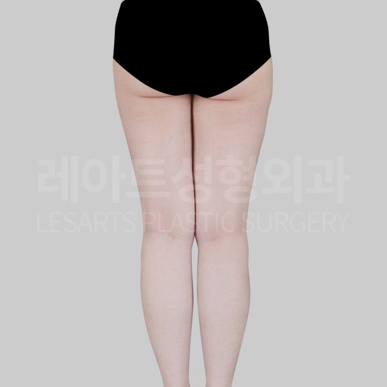 s-thight-liposuction-post22-03