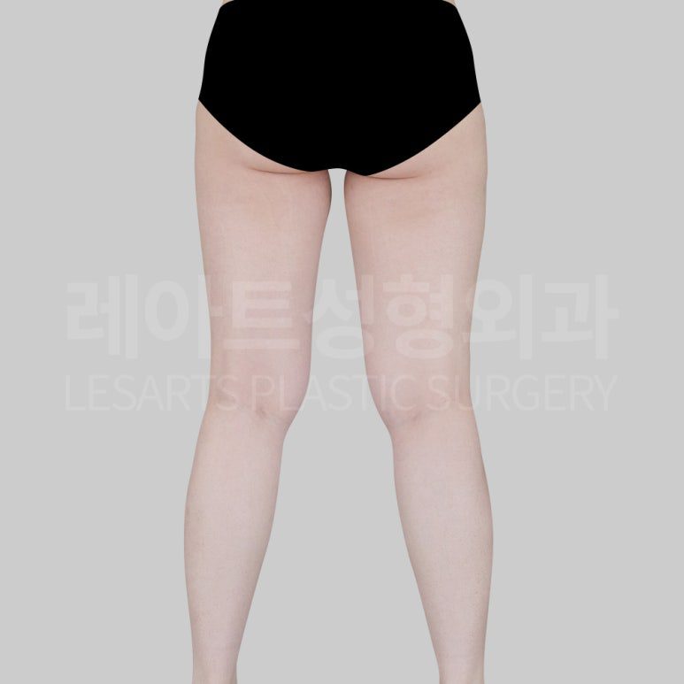 s-thight-liposuction-post22-04