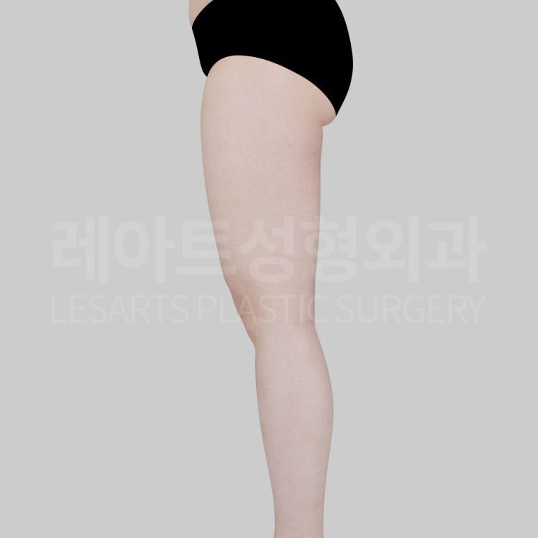 s-thight-liposuction-post22-05