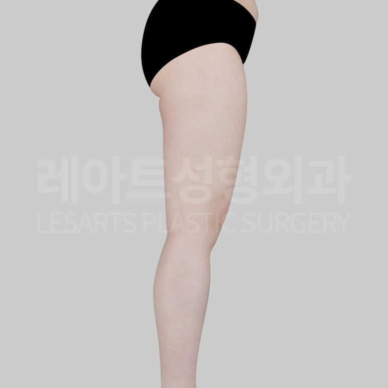 s-thight-liposuction-post22-06