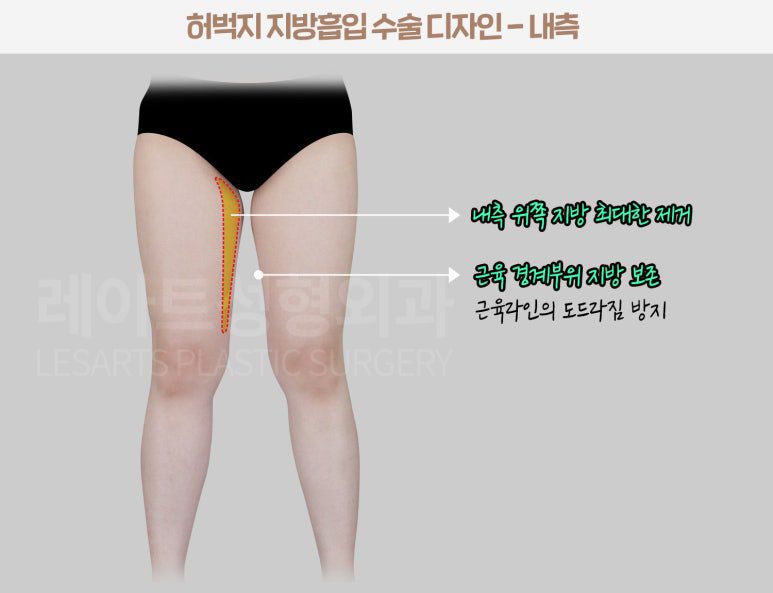 허벅지 지방흡입 수술 전 디자인