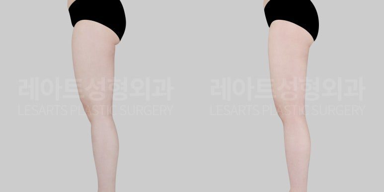 허벅지지방흡입 수술 전후 비교 옆모습