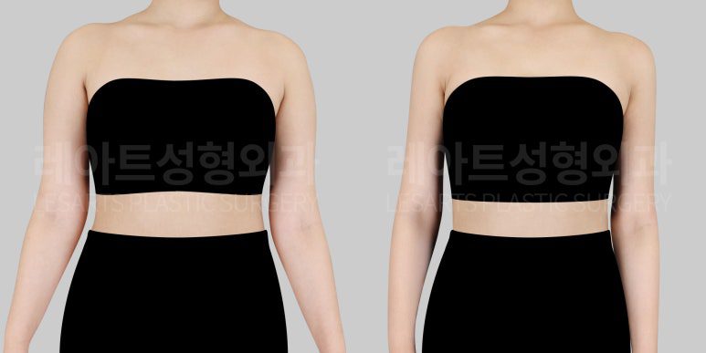 팔 지방흡입 전후사진 비교사진
