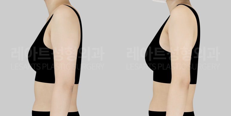 팔 지방흡힙 전후 비교사진