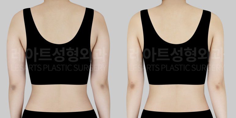 팔지방흡입 전후 비교