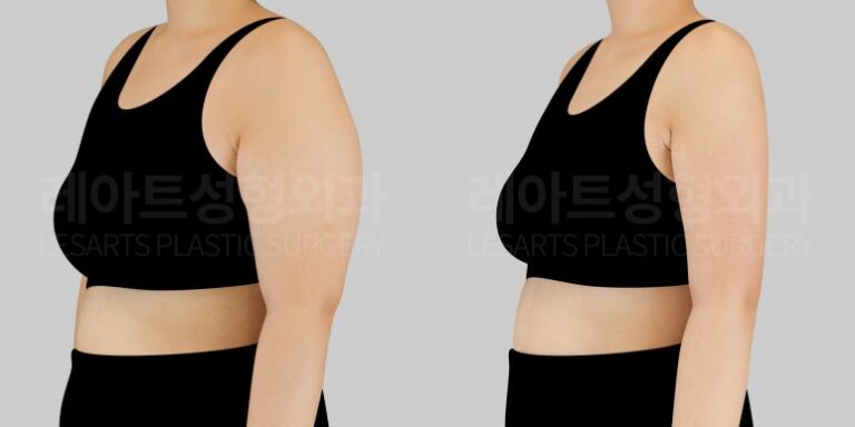 팔 지방흡입 | 살은 빠지는데, 팔뚝살만은 절대 안 빠진다면