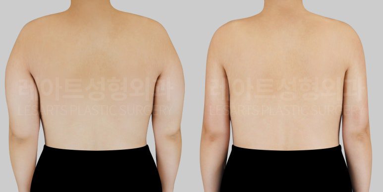 팔 지방흡입 전후 비교사진