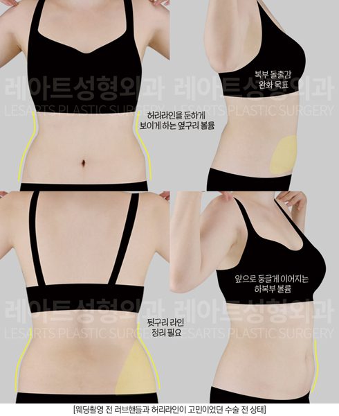 예비신부 복부지방흡입 수술전 플랜