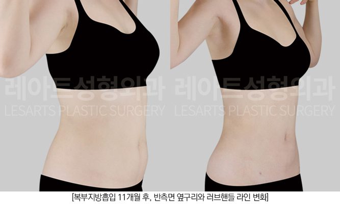 예비신부 복부 지방흡입 레아트 성형외과