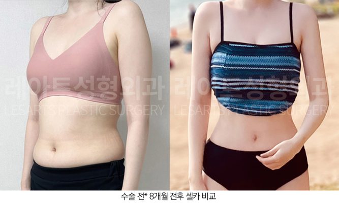 복부지방흡입 전후모습 레아트성형외과