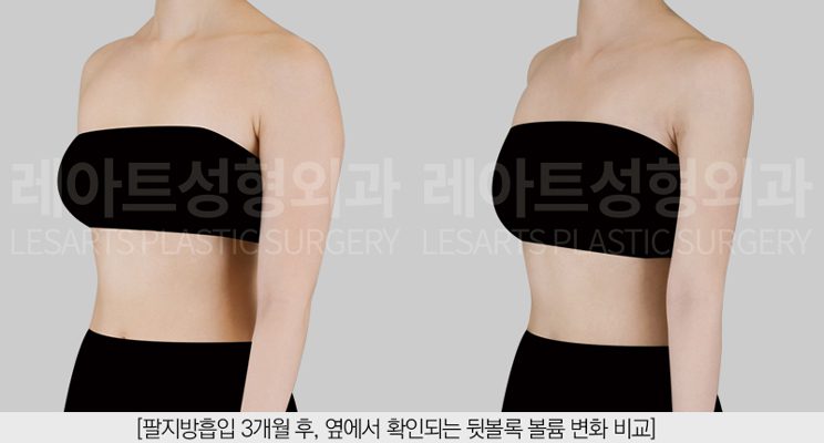 팔지방흡입 전후사진 반측면 - 레아트 성형외과