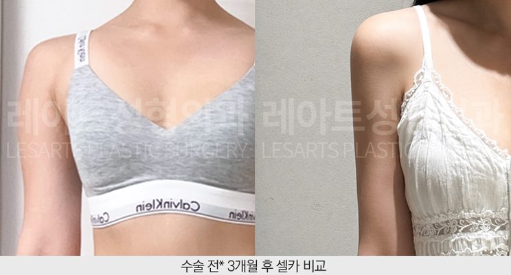 팔지방흡입 전후 셀카사진