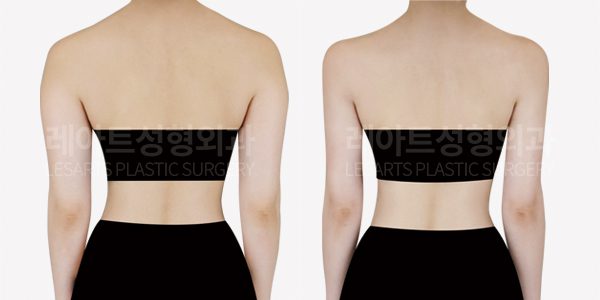 팔 지방흡입 전후사진 뒷모습 - 레아트 성형외과