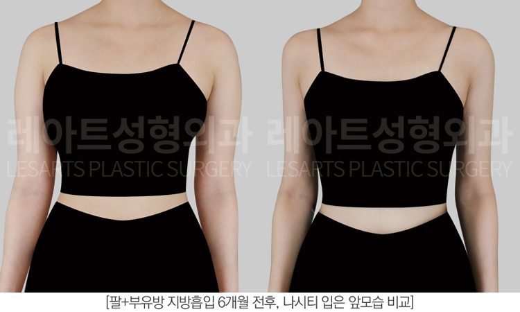 부유방, 팔지방흡입 전후사진 레아트 성형외과
