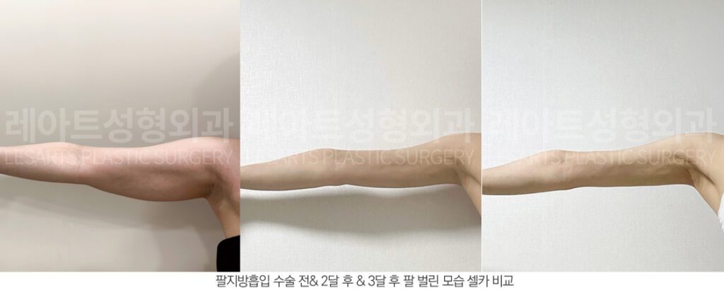 팔 지방흡입 경과별 비교사진 - 레아트 성형외과