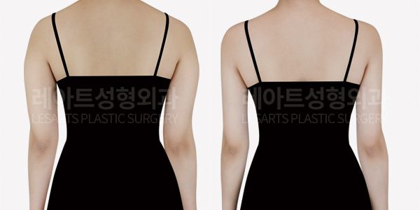 팔 지방흡입 전후사진 - 레아트 성형외과