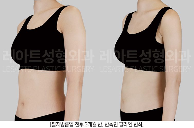 팔 지방흡입 반측면 레아트 성형외과
