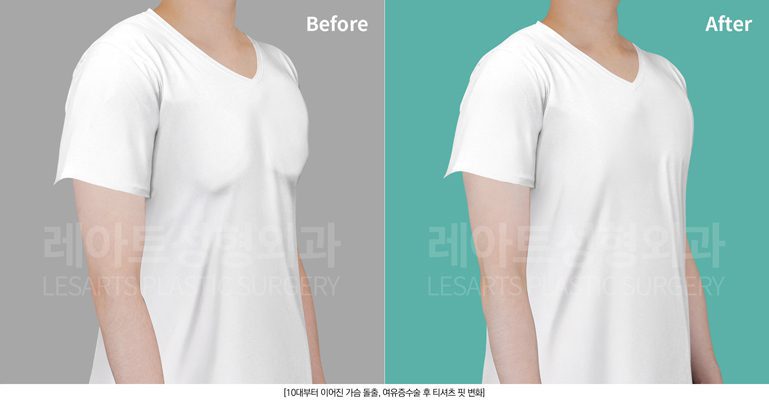 여유증 수술 전후 옷핏 비교 레아트 성형외과