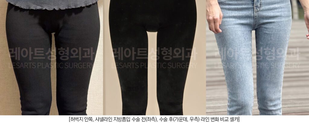 허벅지 지방흡입 전후 셀카 사진 - 레아트 성형외과