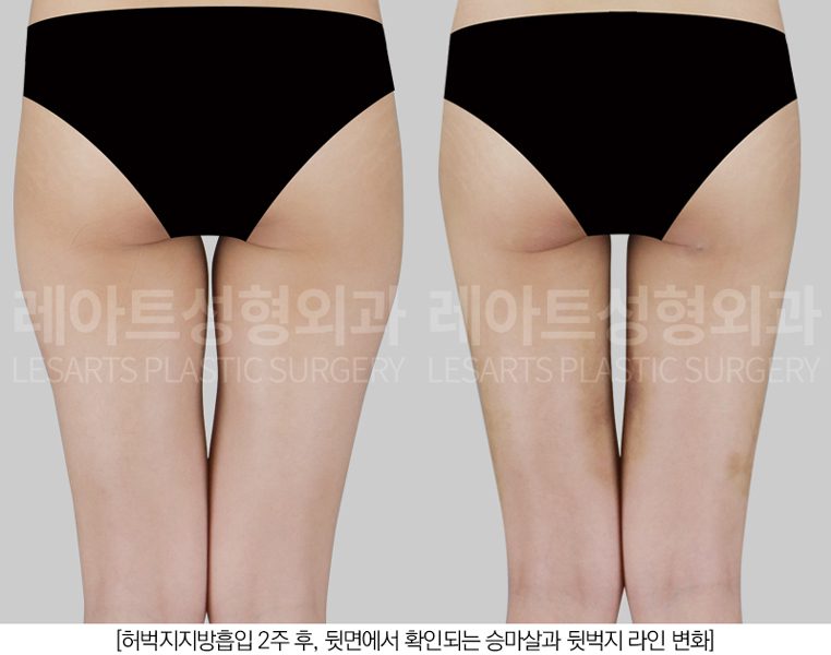 허벅지지방흡입 전후사진 레아트 성형외과