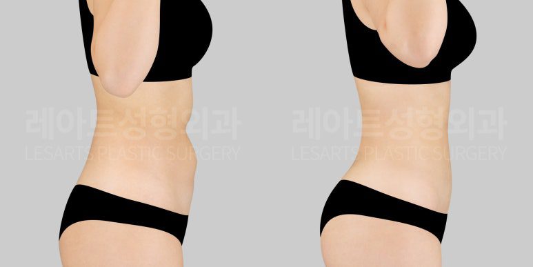 복부 지방흡입 전후 비교- 레아트 성형외과