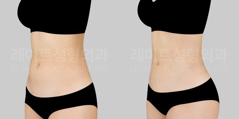 복부 지방흡입 전후사진 반측면 - 레아트 성형외과