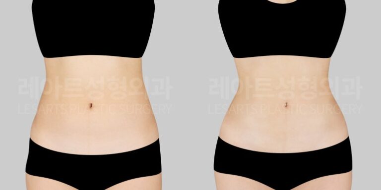 복부지방흡입 레아트성형외과