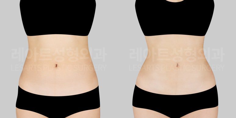 복부지방흡입 레아트성형외과
