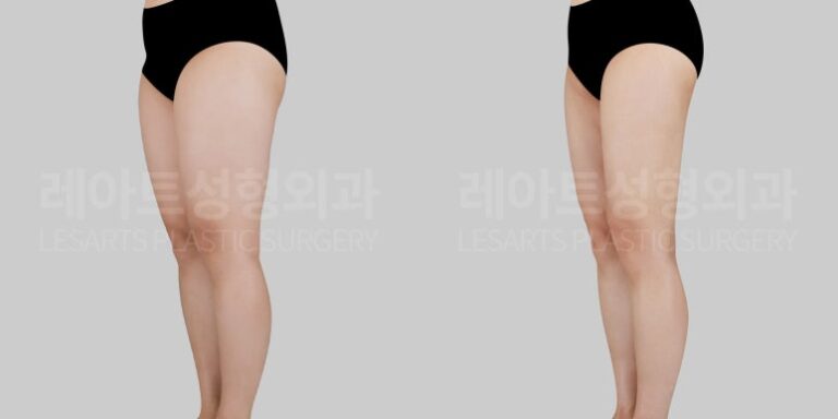 레아트 허벅지지방흡입 레아트 성형외과