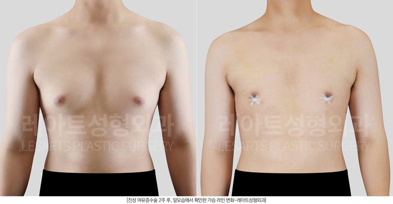 여유증 수술 전후 앞모습 비교 - 레아트성형외과