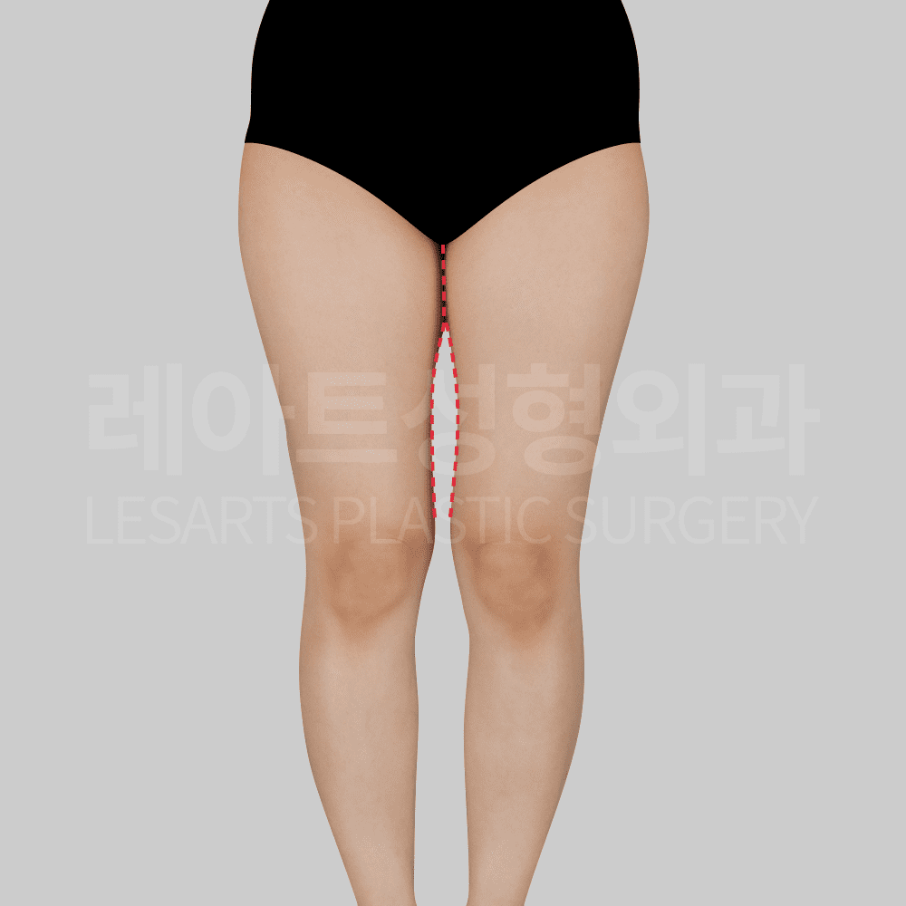 thigh_liposuction 허벅지 지방흡입 전