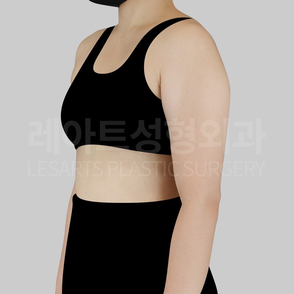 1-3_28996__armliposuction_before_03