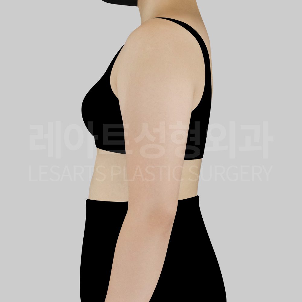 1-4_28996__armliposuction_before_04
