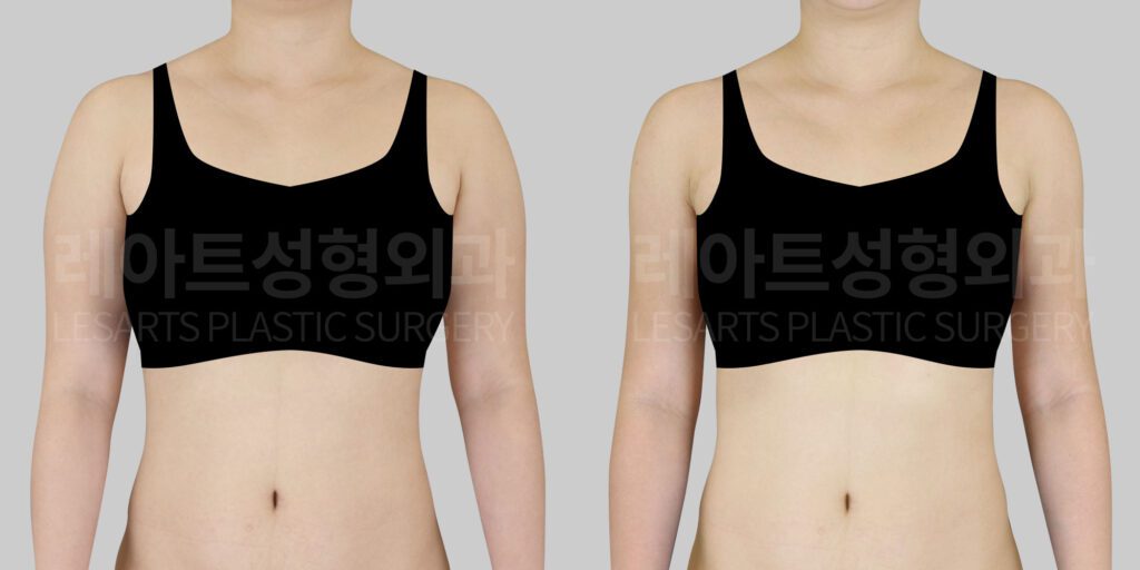 arm liposuction 팔 지방흡입 팔뚝 지방흡입