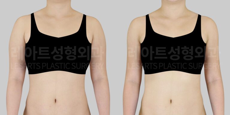 arm liposuction 팔 지방흡입 팔뚝 지방흡입