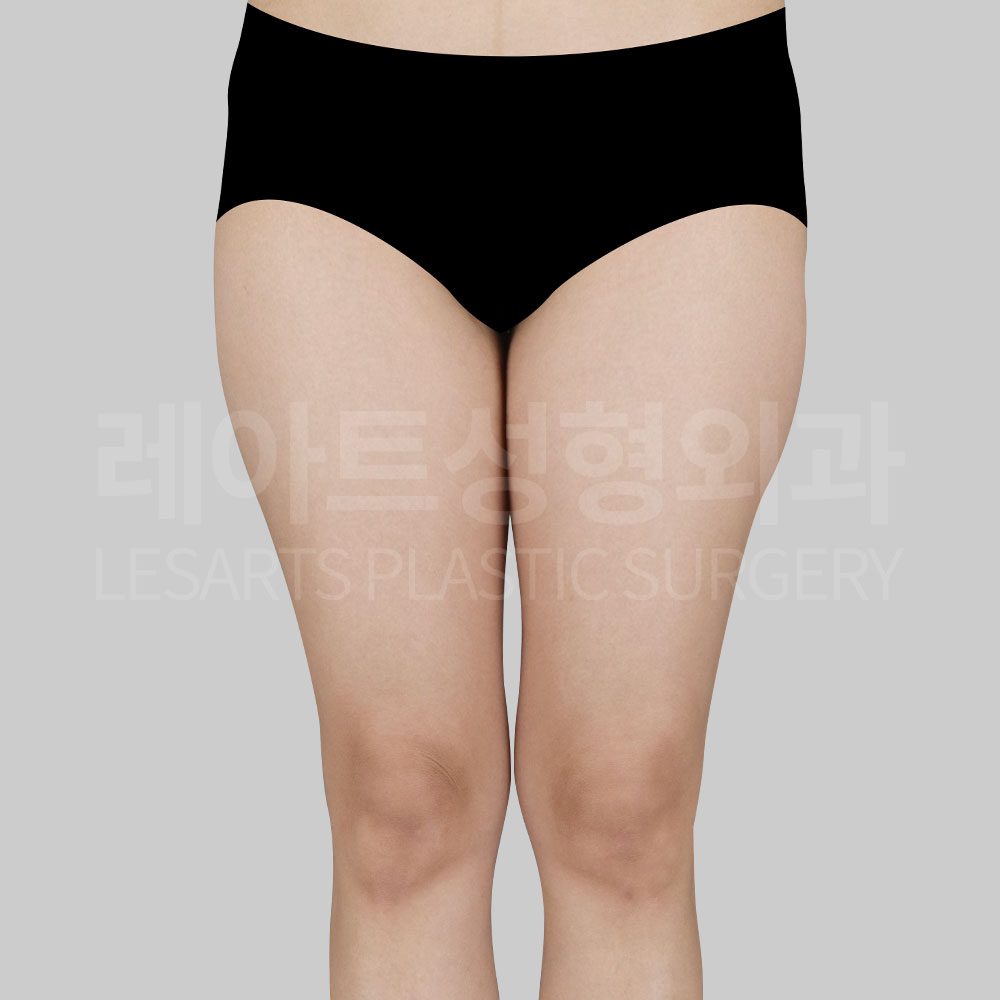 1_25862_ thigh_liposuction