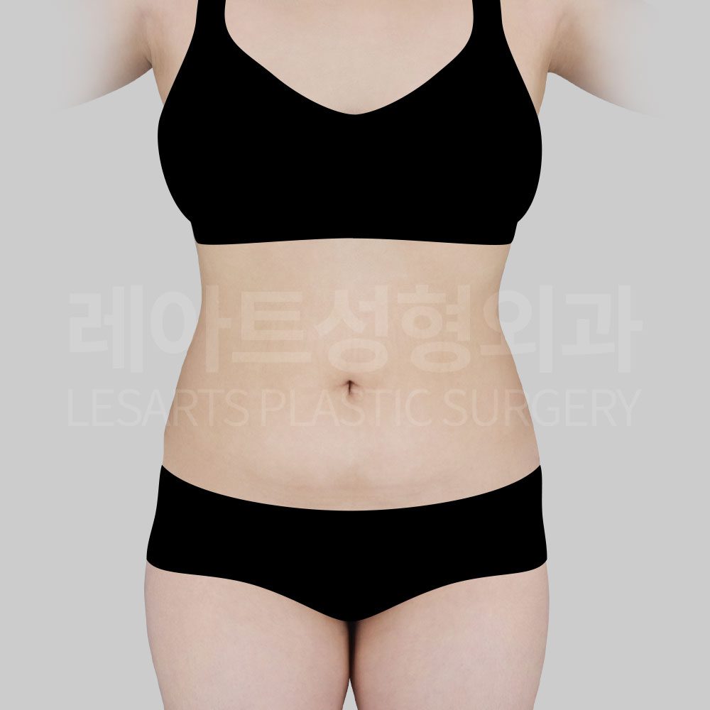 abdominal_liposuction_복부지방흡입