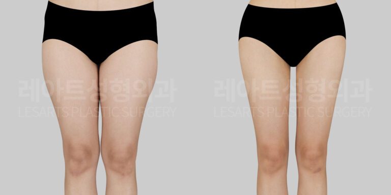 thigh liposuction 허벅지 지방흡입 다리 지방흡입 지방흡입 전후