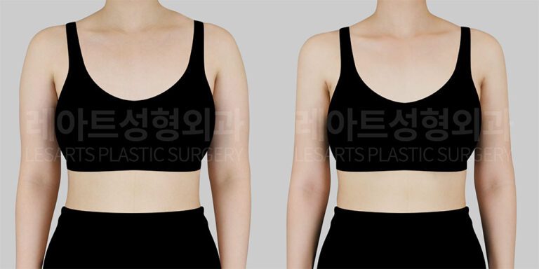 arm_liposuction 팔 지방흡입 팔라인 지방흡입