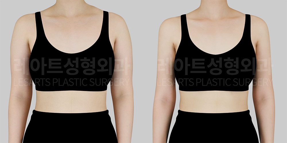 arm_liposuction 팔 지방흡입 팔라인 지방흡입