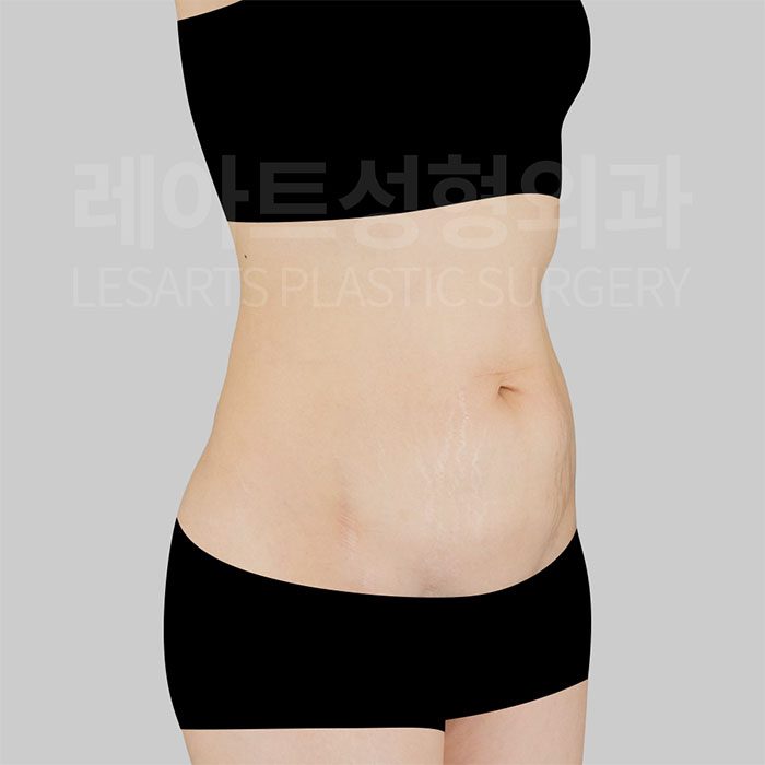 3-abdominoplasty-30075-before